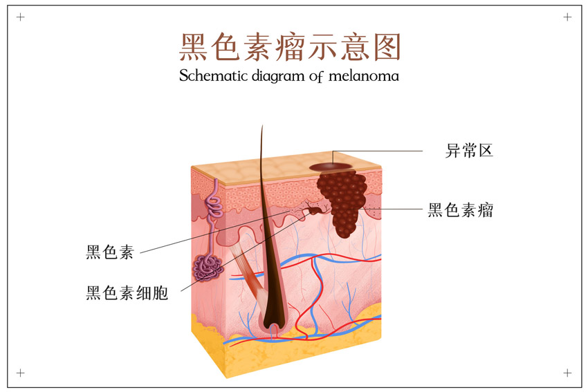 攝圖網(wǎng)_401794778_banner_黑色素瘤示意圖（企業(yè)商用）